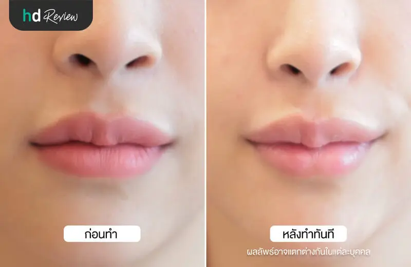 เปรียบเทียบก่อนและหลังฉีดฟิลเลอร์ปาก Yvoire ที่ Flow Clinic