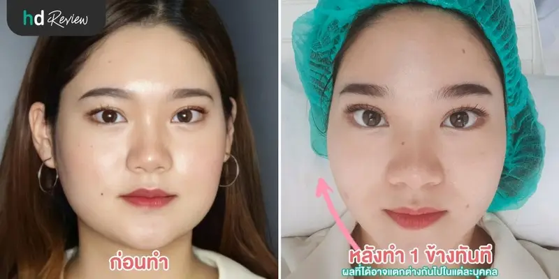 รีวิว เก็บกรอบหน้า ด้วยโปรแกรม Max Lift ที่ Pimtara Estetica Clinic