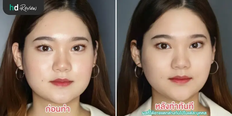 รีวิว เก็บกรอบหน้า ด้วยโปรแกรม Max Lift ที่ Pimtara Estetica Clinic