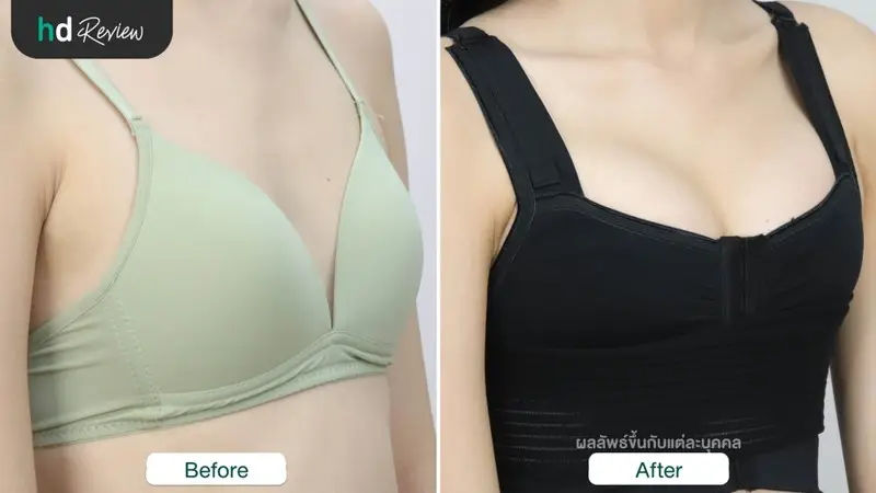 content review nagor silicone enhancement at siraikorn clinic by kunwadee maruttawong 3