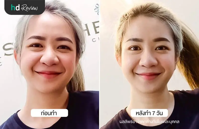 รีวิว NeckTite ดูดไขมันเหนียงและกรอบหน้า ที่ HERS Clinic