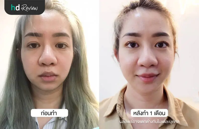รีวิว NeckTite ดูดไขมันเหนียงและกรอบหน้า ที่ HERS Clinic