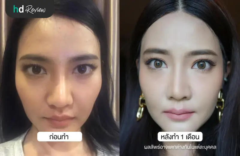 รีวิว ศัลยกรรมเสริมซิลิโคนร่องแก้ม ที่ HERS Clinic