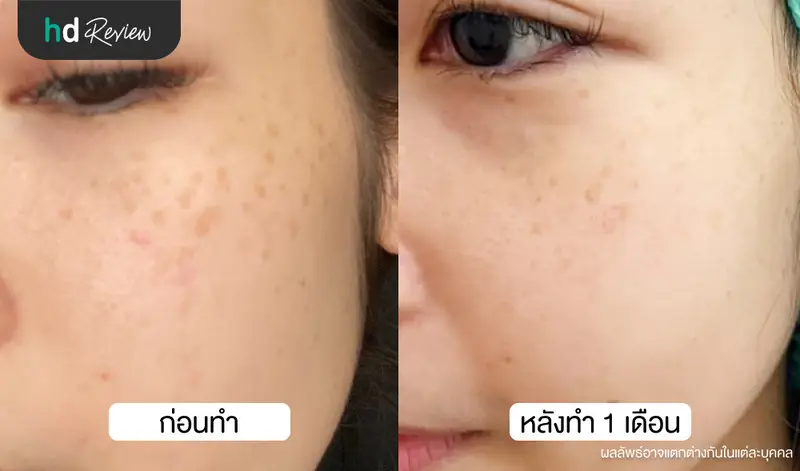 เปรียบเทียบก่อนและหลังเลเซอร์กระด้วย Picocare 450