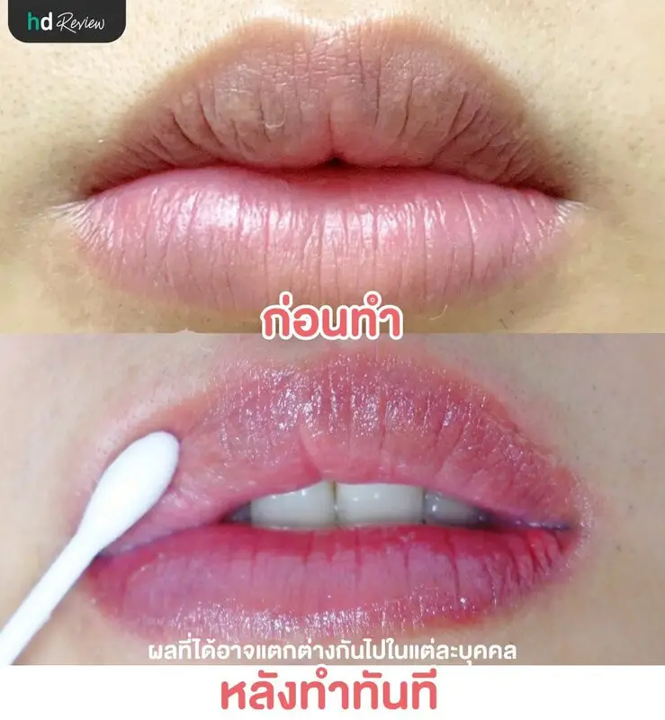 Before After เลเซอร์ปาก