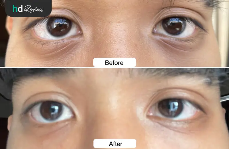 รีวิว ฉีด PRP ลดรอยคล้ำใต้ตา ที่ All Amaze Clinic