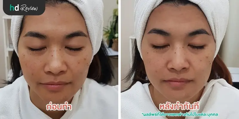 ผิวกระจ่างใสด้วย Signature Blink Massage ที่ บีบีคลินิก (BB Clinic) 15 รีวิวนวดหน้าด้วยมือสำหรับผิวแห้งหมองคล้ำ Signature Blink Massage