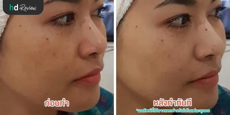 ผิวกระจ่างใสด้วย Signature Blink Massage ที่ บีบีคลินิก (BB Clinic) 16 รีวิวนวดหน้าด้วยมือสำหรับผิวแห้งหมองคล้ำ Signature Blink Massage