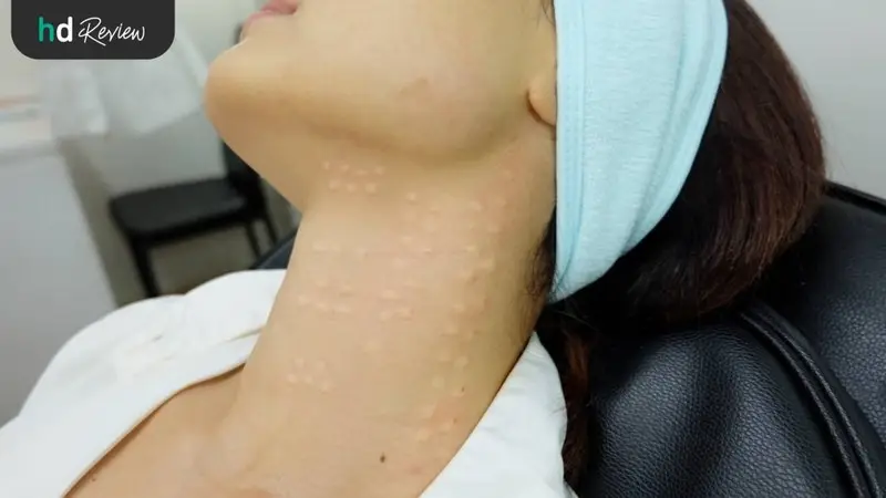 ขั้นตอนการทำเมโส Pink Line Signature Divine Lift กราม คอ ที่ Divine Aesthetic Clinic