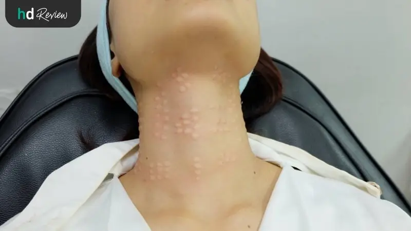 ขั้นตอนการทำเมโส Pink Line Signature Divine Lift กราม คอ ที่ Divine Aesthetic Clinic