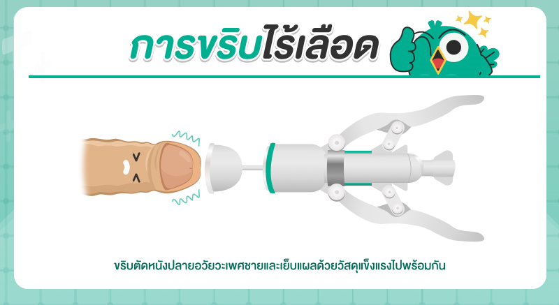 ขริบไร้เลือดคืออะไร