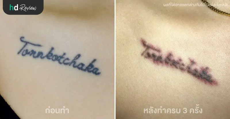 ภาพเปรียบเทียบก่อนทำและหลังลบรอยสักด้วย PicoWay ครบ 3 ครั้ง