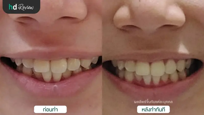รีวิว ขูดหินปูน ขัดฟัน เคลือบฟลูออไรด์ ที่ คลินิกทันตกรรมสไมล์โซไซตี้