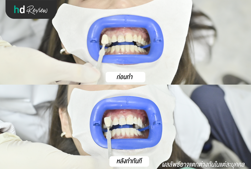 ผลลัพธ์หลังฟอกสีฟันแบบ Zoom