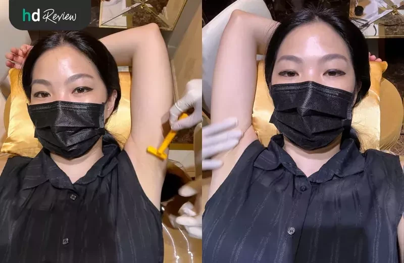 ขั้นตอนการทำเลเซอร์ขนรักแร้ ด้วย Gentle YAG Pro-U ที่ F Clinic