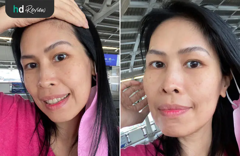 รีวิว ทำ HIFU Ultra Lift บริเวณแก้ม ที่ DPC Beauty Clinic