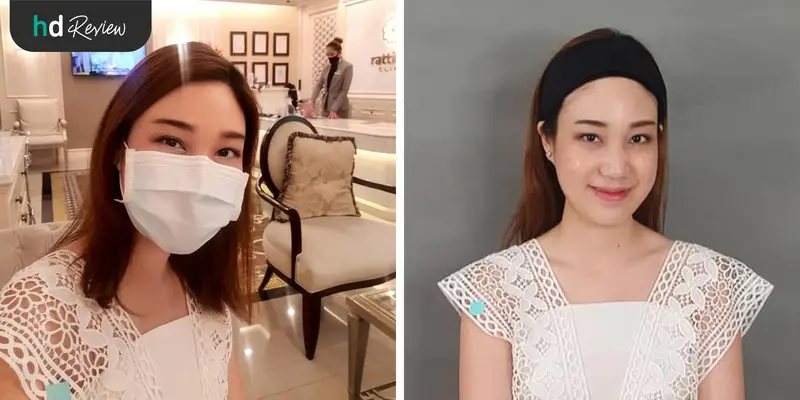 รีวิว Pico Second Laser ลดกระฝ้าบนใบหน้า ที่รัตตินันท์คลินิก