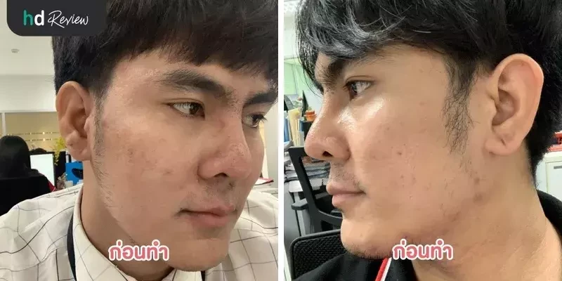 ภาพก่อนทำ Dermatrix รักษาหลุมสิว ที่ Gentle Clinic