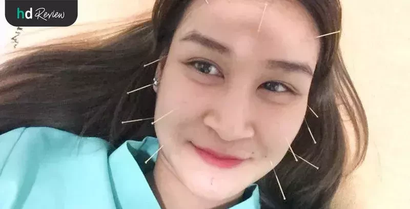 ผู้ใช้บริการฝังเข็มหน้าใส ที่ Mandarin Clinic