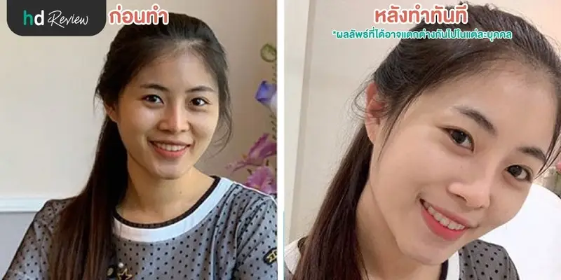 นวดหน้าด้วย Dermasport ฟื้นฟูผิวเสียหลังออกแดด ที่ บีบีคลินิก (BB Clinic) 6 HDreview นวดหน้า Dermaspot ที่ BB Clinic