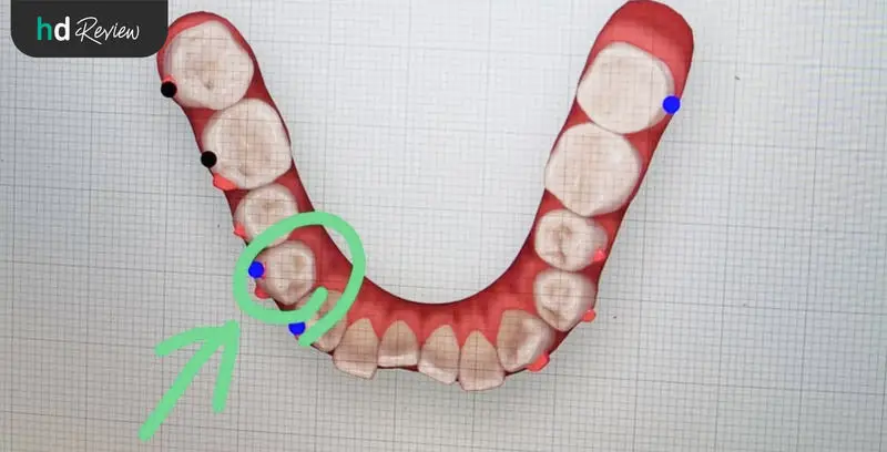 จัดฟันครั้งที่ 2 เพิ่มความมั่นใจด้วย Invisalign ที่ Deezy Dental Home 6 ภาพอธิบายการจัดฟันแบบ Invisalign ที่ Deezy Dental Home