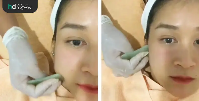 ขั้นตอนการฝังเข็มหน้าใส ทรีตเมนต์กัวซา ที่ Mandarin Clinic