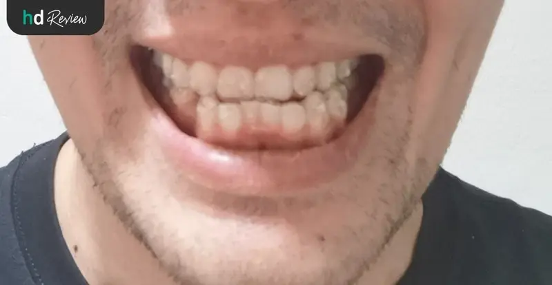 ภาพใส่อุปกรณ์จัดฟัน Invisalign