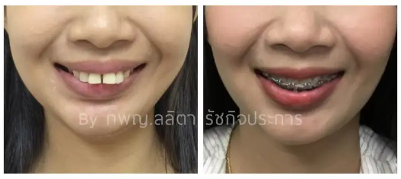 รีวิวจัดฟันแก้ฟันเหยิน ที่ คลินิกฟันยิ้ม ราม 2