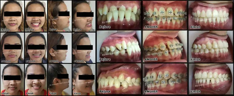 รีวิวจัดฟันแก้ปัญหาฟันล่างคร่อมฟันบน ที่ คลินิกฟันยิ้ม ราม 2