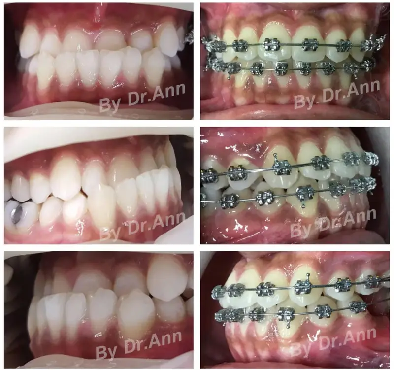 รีวิวจัดฟันแก้ปัญหาฟันล่างคร่อมฟันบน ที่ คลินิกฟันยิ้ม ราม 2