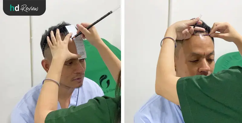 ขั้นตอนการปลูกผม ด้วยเทคนิค FUE ที่ GROW & Clinic วันที่ 2