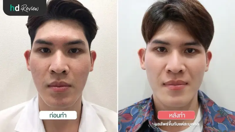 เปรียบเทียบ ก่อนและหลังฉีดหลุมสิว WOW Scar Removal ที่ WOW Clinic