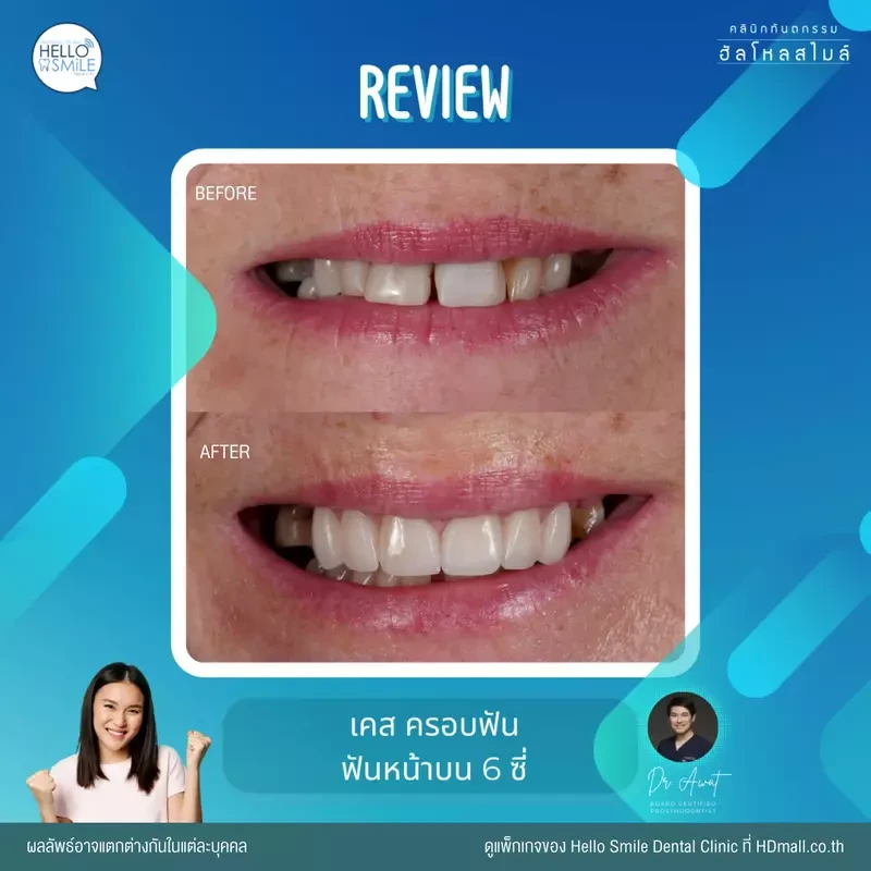 รีวิว ทำครอบฟัน ที่ Hello Smile Dental Clinic