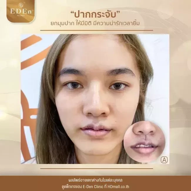 รีวิว ศัลยกรรม ปากกระจับ ที่ E-Den Clinic