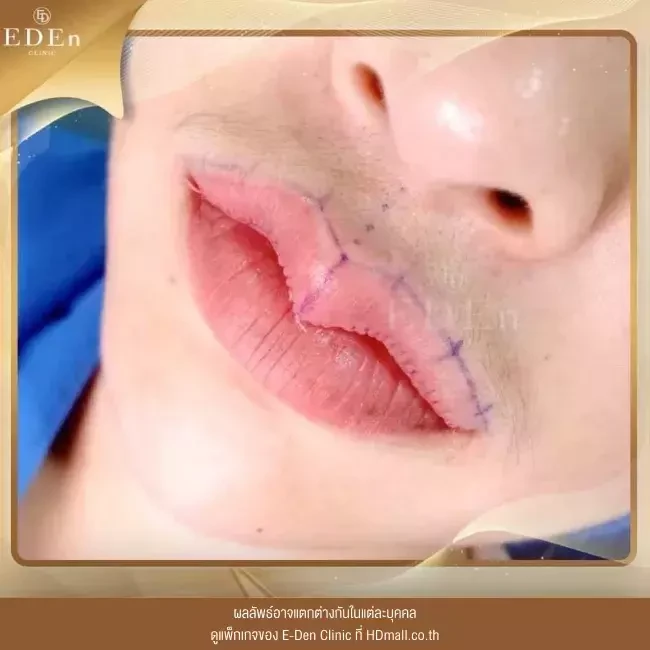รีวิว ศัลยกรรม ปากกระจับ ที่ E-Den Clinic