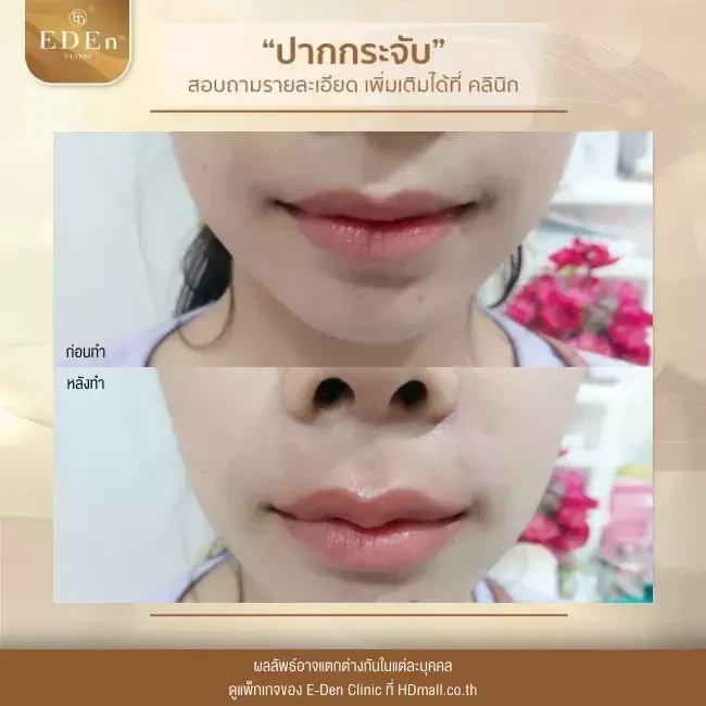 รีวิว ศัลยกรรม ปากกระจับ ที่ E-Den Clinic