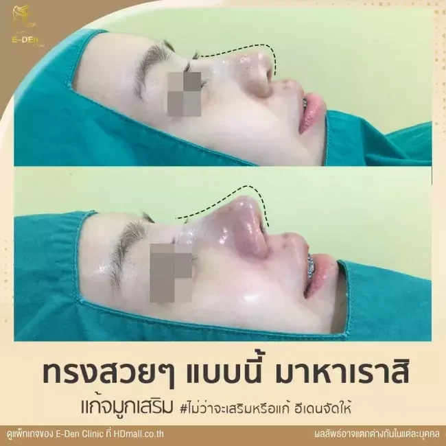 รีวิว เสริมจมูกแบบ Open เชียงใหม่ ที่ E-Den Clinic