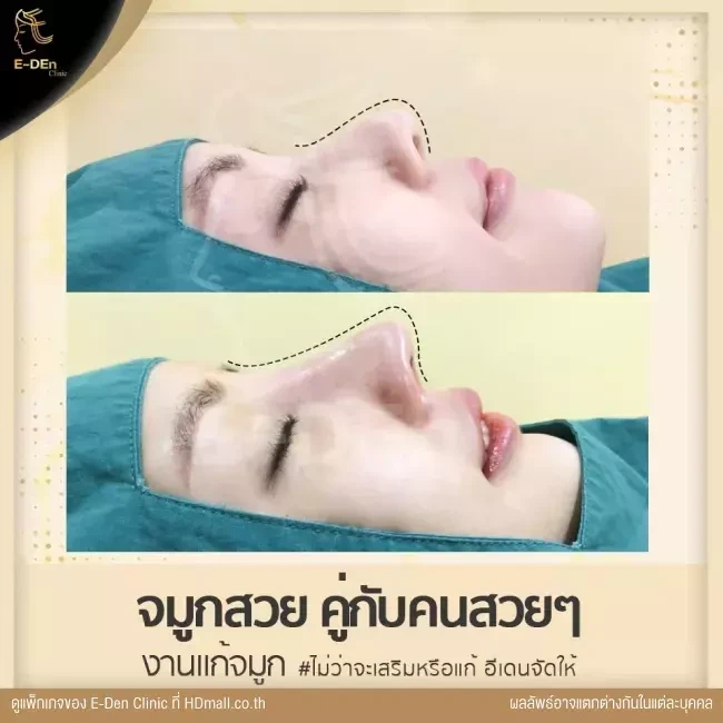 รีวิว เสริมจมูกแบบ Open เชียงใหม่ ที่ E-Den Clinic