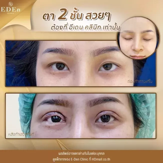 รีวิว ทำตาสองชั้น ที่ E-Den Clinic