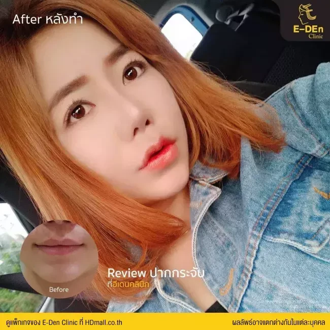 รีวิว ศัลยกรรม ปากกระจับ ที่ E-Den Clinic
