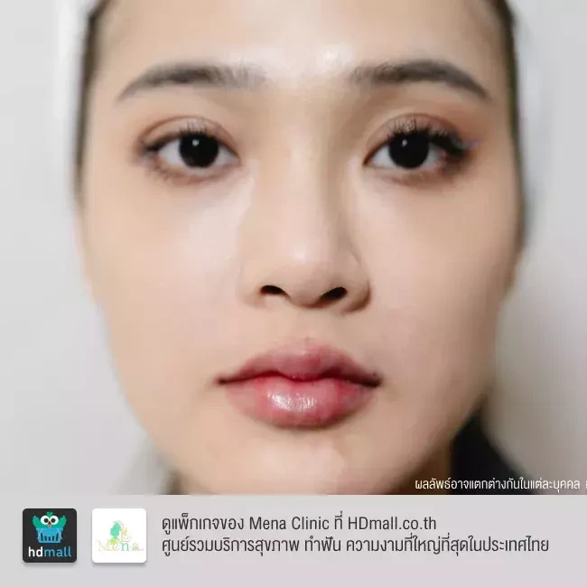 รีวิว ฉีดฟิลเลอร์ปาก ที่ Mena Clinic