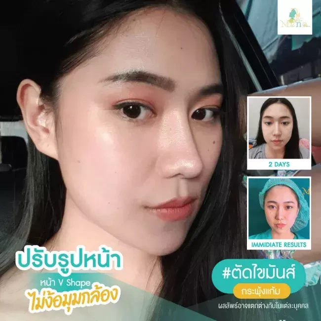Before After รีวิว ตัดไขมันกระพุ้งแก้ม ที่ Mena Clinic
