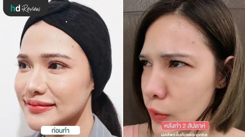 1 content review botulinum toxin injections korea aestox at anjali clinic by neeranara boonchuai 1