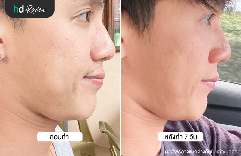 รีวิว Cryo V สลายไขมันเหนียงด้วยความเย็น ที่ Wink Clinic