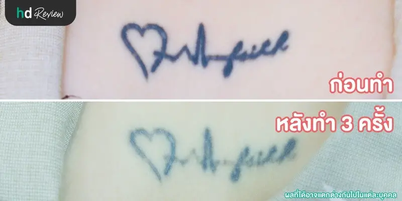1 content review tattoo removal picoway at the sign clinic by hathaikorn ploysangngam 2