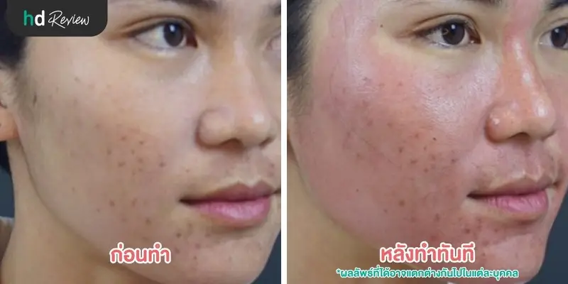 รีวิวรักษารอยสิว หลุมสิว ด้วย PicoWay ที่ The Sign Clinic
