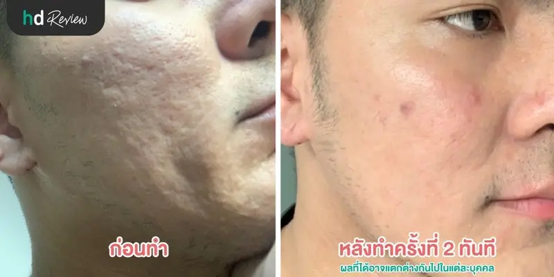 ภาพเปรียบเทียบก่อนทำกับหลังทำครั้งที่ 2