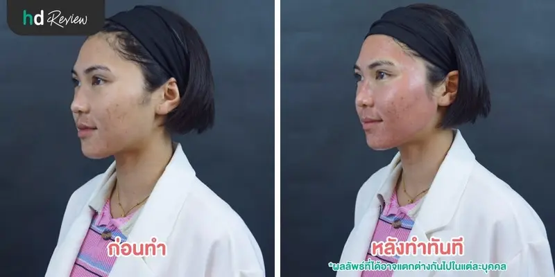 รีวิวรักษารอยสิว หลุมสิว ด้วย PicoWay ที่ The Sign Clinic