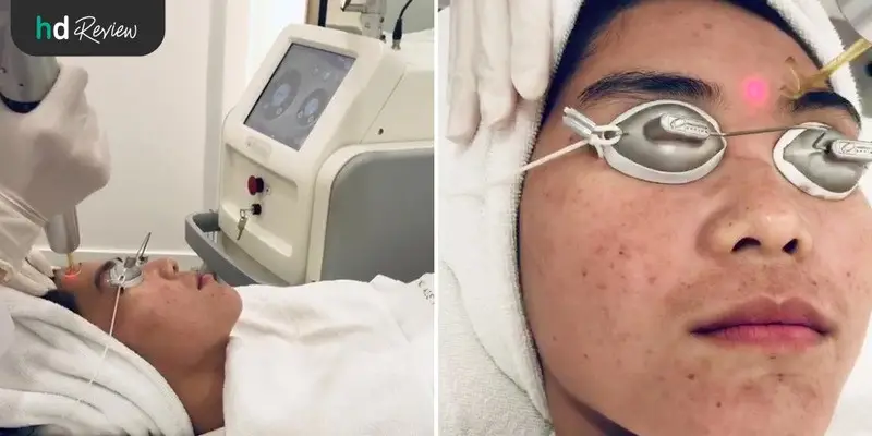 รีวิวรักษารอยสิว หลุมสิว ด้วย PicoWay ที่ The Sign Clinic