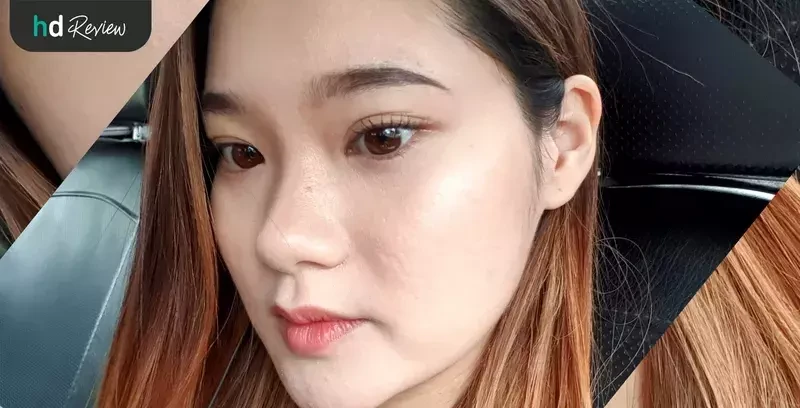ผู้ใช้บริการผลลัพธ์การใช้บริการเลเซอร์รักษารอยแผลเป็นจากสิวและหลุมสิว ที่ The Sign Clinic
